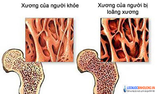 So sánh xương người khỏe mạnh và loãng xương